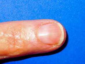 White nail - Leukonychia: An overview — DermNet