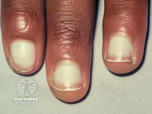 Horizontal White Lines On Fingernails White Nail Leukonychia An Horizontal White Lines On Fingernails White Nail Leukonychia An