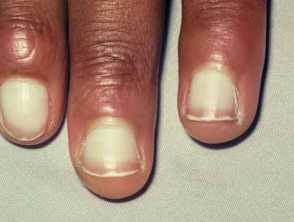 Why is the white part of my nail going over the pink part of my nail. Is  something wrong with them? - Quora