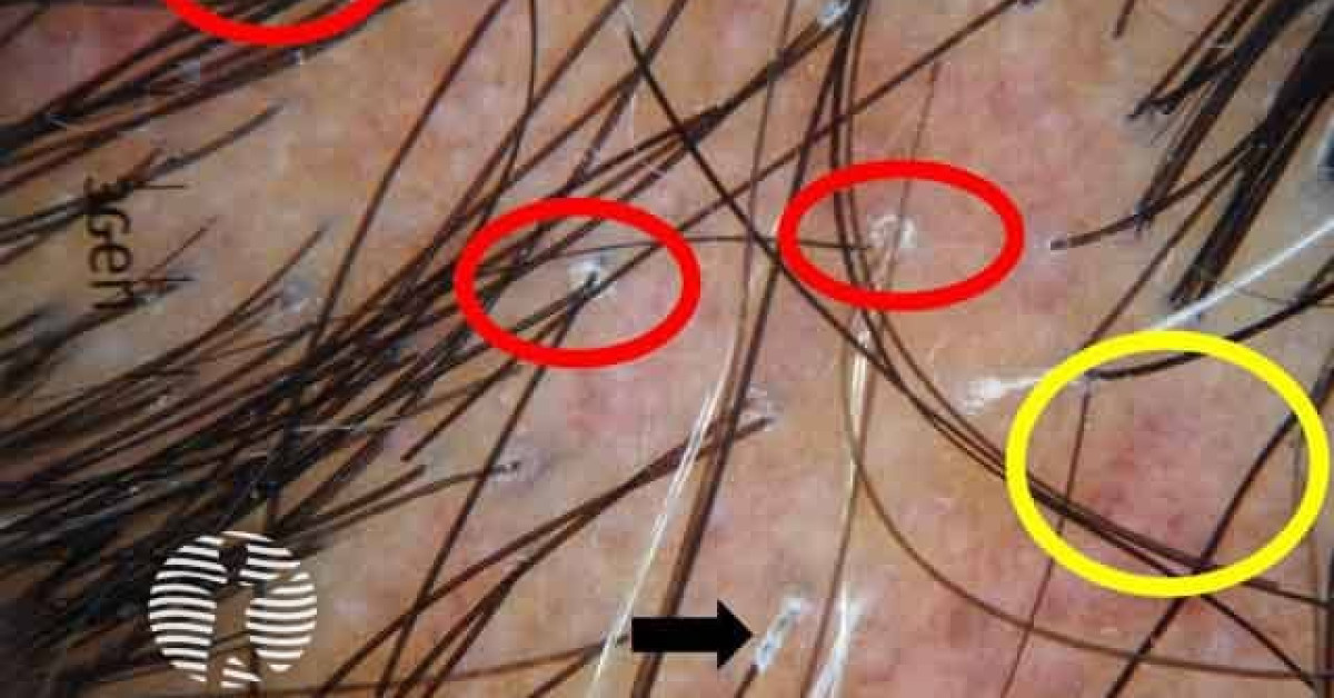 Lichen Planopilaris Image lichen-planopilaris-image