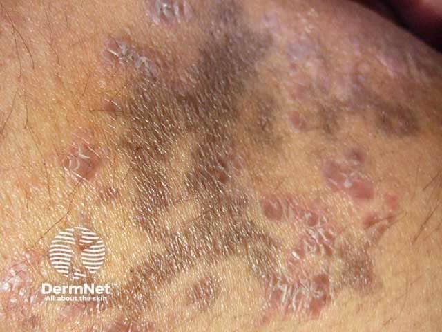 Active lichen planus with co-existing post inflammatory hyperpigmentation