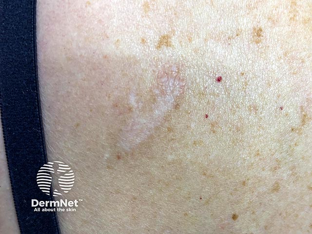 A pale slightly scaly plaque with a violaceous edge on the back due to lichen sclerosus<br />
