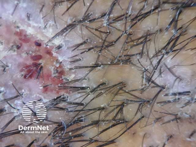Dermoscopic image of trichoptilosis; distal splitting and damage of the hair shaft and extravasated blood in a patient with lichen simplex chronicus.
