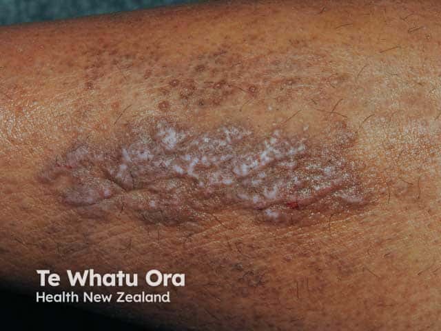 Thickening of the skin and hyperpigmentation due to lichen simplex on the shin