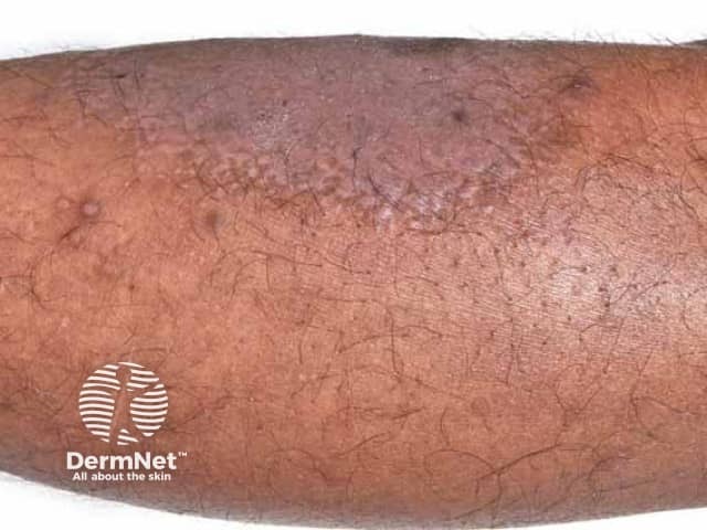 Hyperkeratosis and hyperpigmentation due to shin lichen simplex