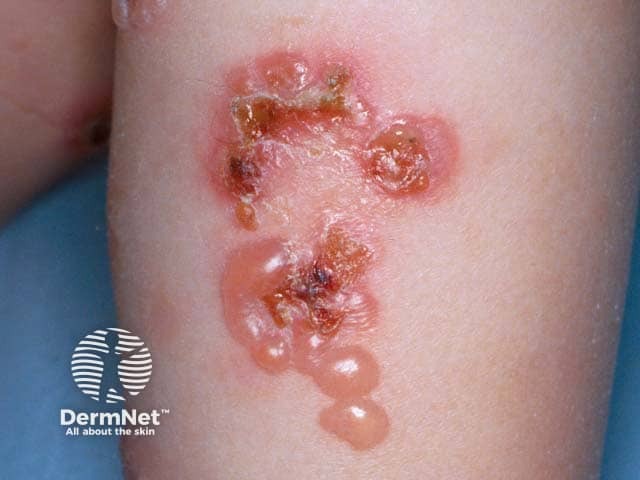 'String of beads' sign in a child with linear IgA disease