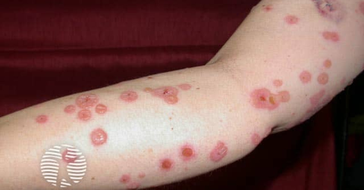 Linear IgA bullous disease image