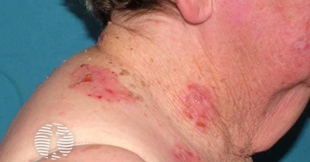 DermNet® - Linear IgA bullous disease image