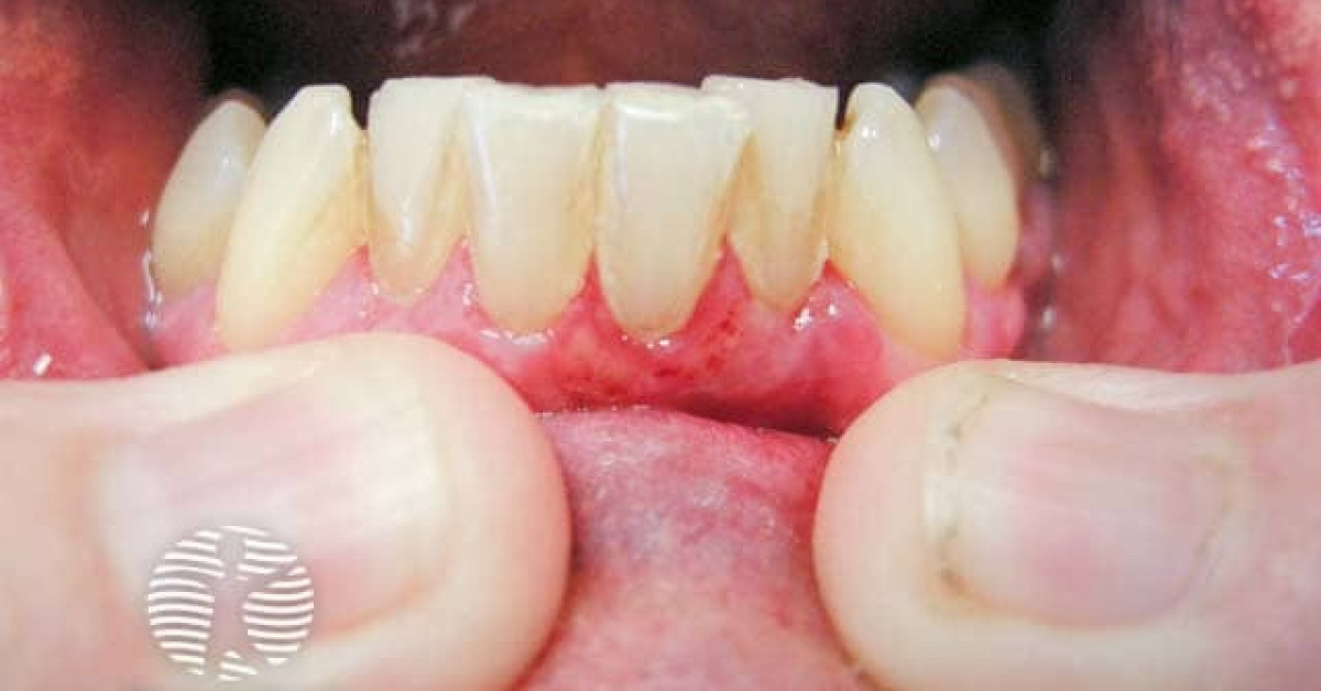 Linear IgA bullous disease image