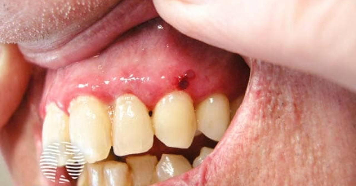 Linear IgA bullous disease image