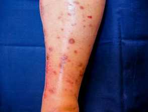 Linear IgA bullous disease