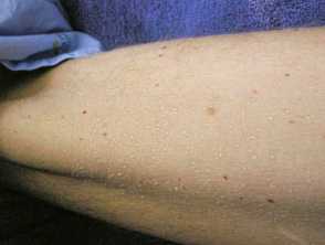 Linear IgA bullous disease