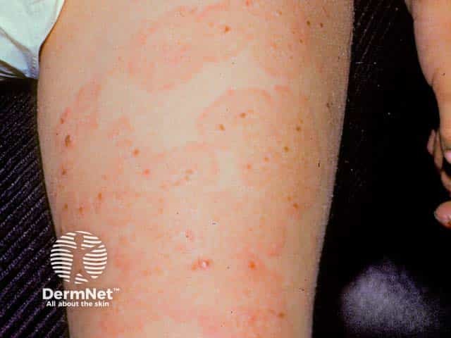 Urticated erythema in linear IgA disease