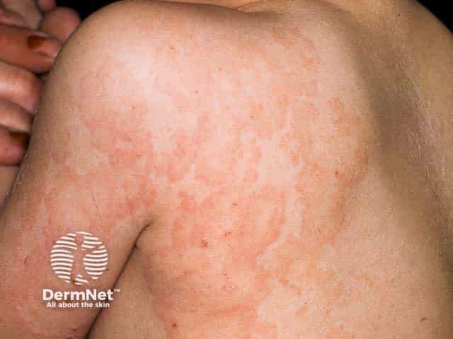 Urticated erythema in Linear IgA disease