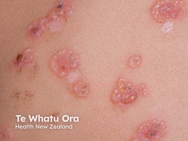 String of pearls blisters in linear IgA disease