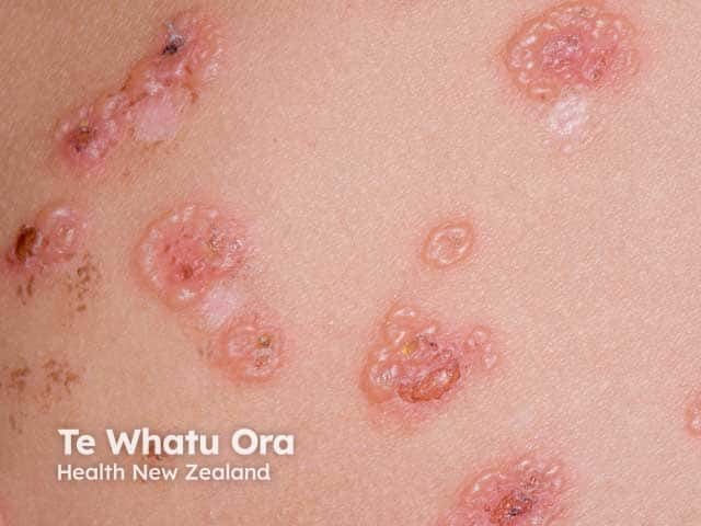 String of pearls blisters in linear IgA disease