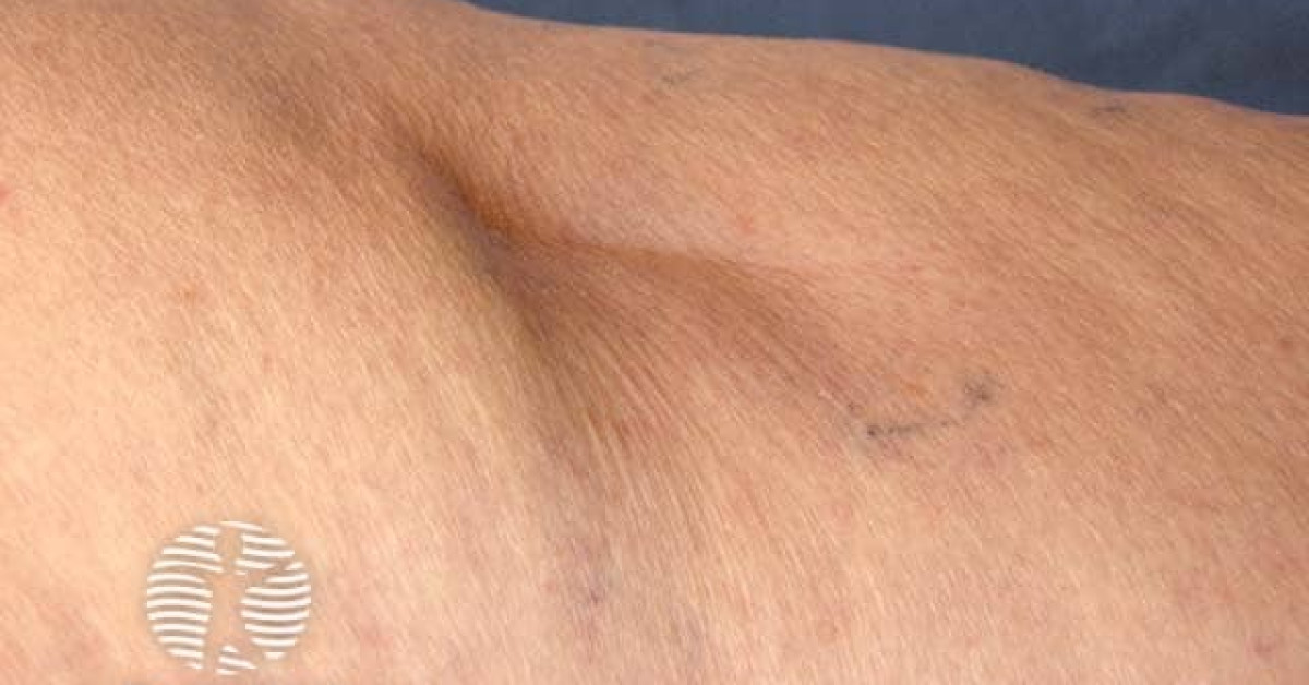Lipodystrophy image