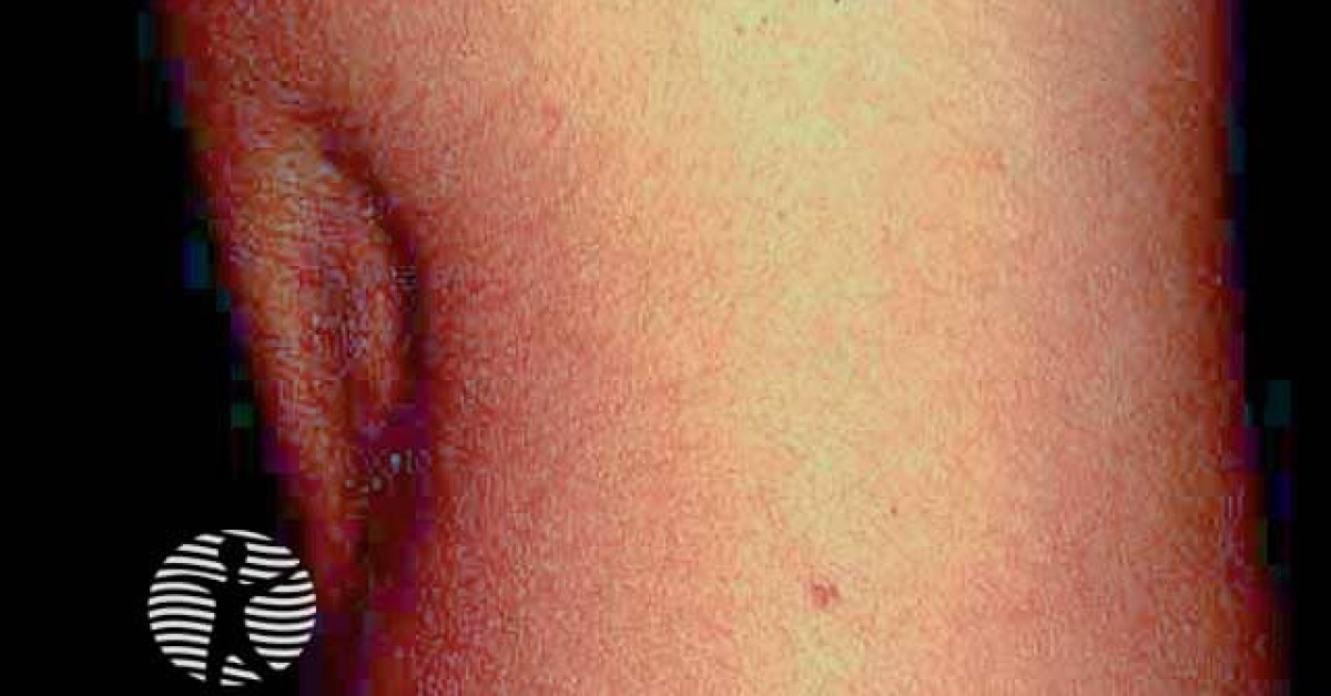 Lipodystrophy Example Lipodystrophy image