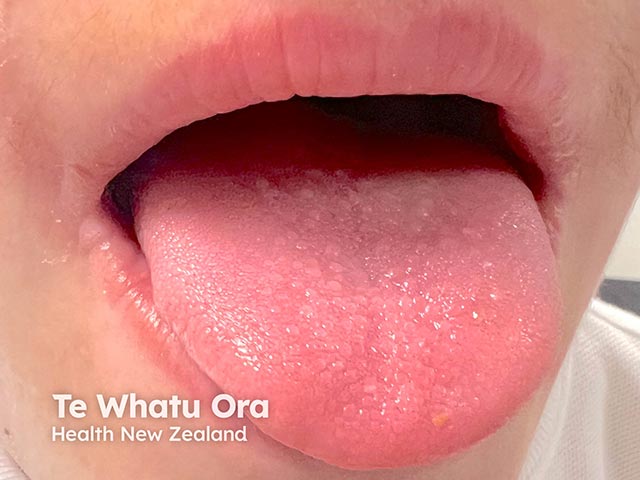 Papular lesions on the tongue in lipoid proteinosis