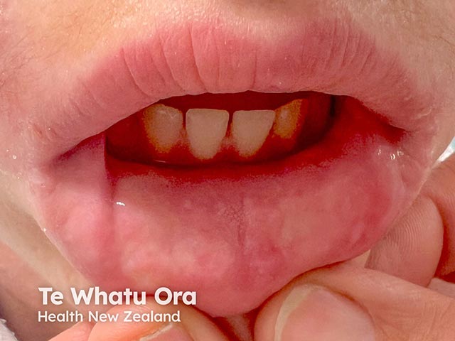 Pale papules and plaques on the lip in lipoid proteinosis