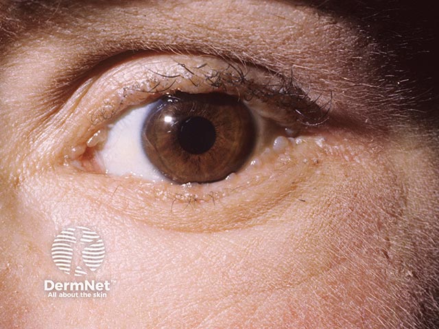 The characteristic pale eyelid papules of lipoid proteinosis