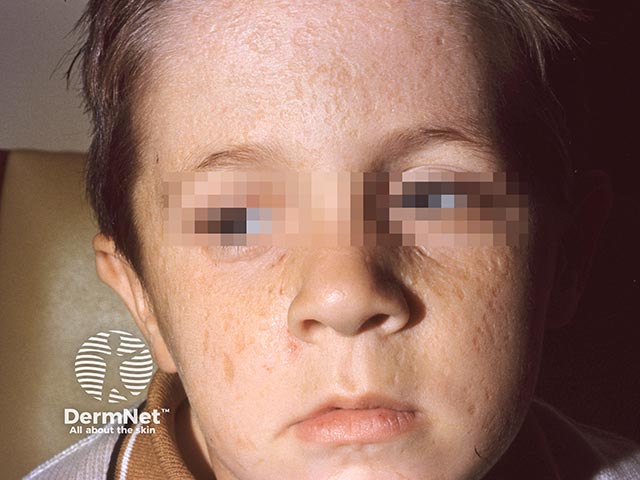 Multiple facial scars due to healed blisters in facial lipoid proteinosis