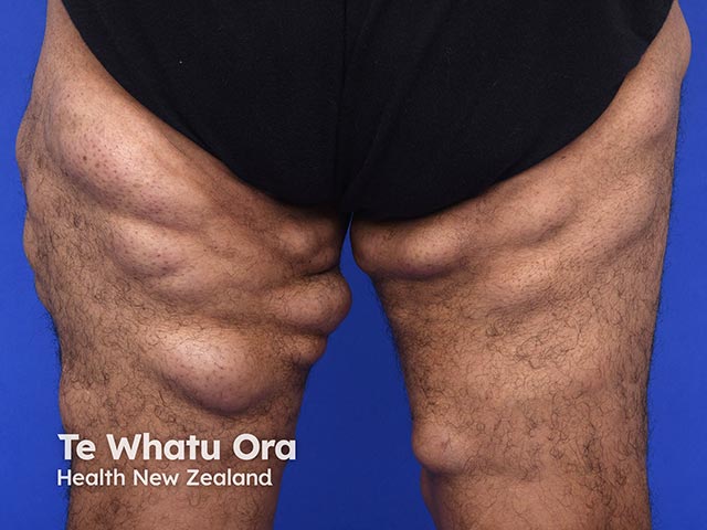 Multiple encapsulated lipomas on the posterior thighs