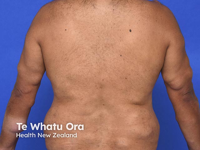 Multiple lipomatosis affecting both arms and back