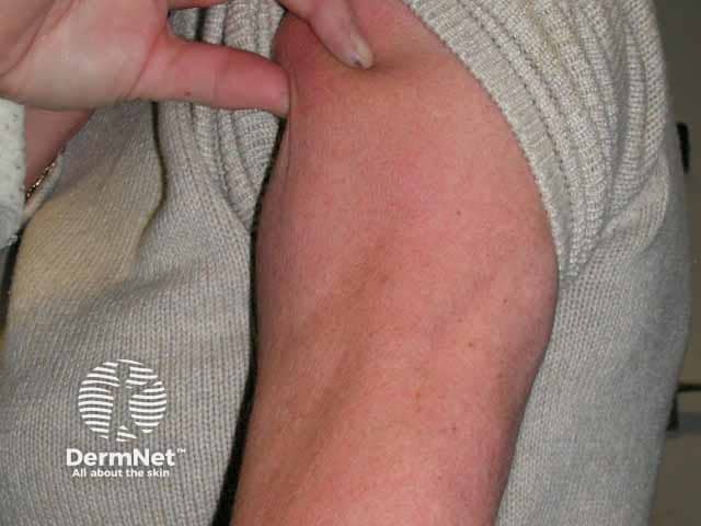 Acquired progressive acral lipoatrophy (fat loss) on lower arm, preservation over deltoids