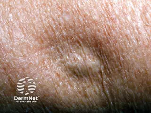 Steroid injection induced lipoatrophy on the arm