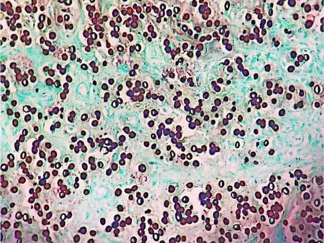 Grocot staining of lobomycosis showing oval yeast-like bodies