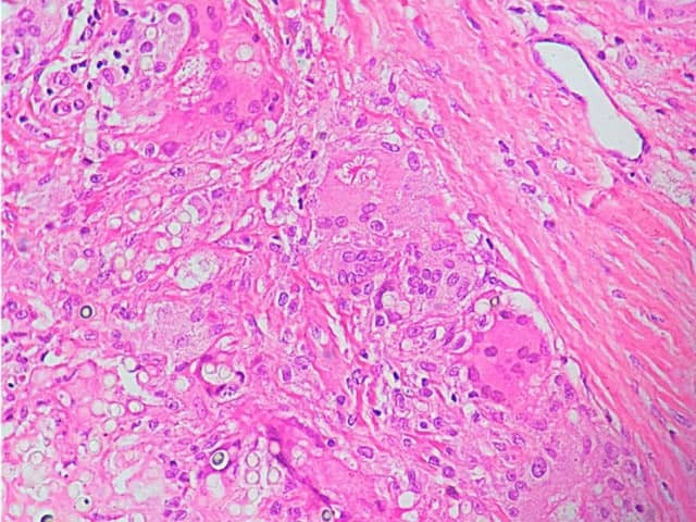 Granulomatous inflammation with giant cells and asteroid body due to lobomycosis