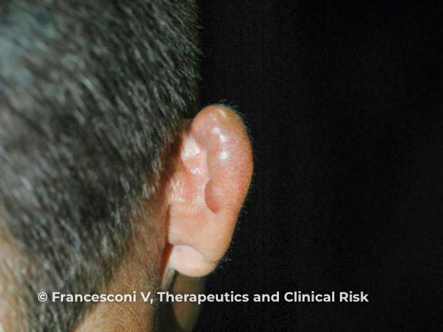 Keloid-like nodules on the ear due to lobomycosis