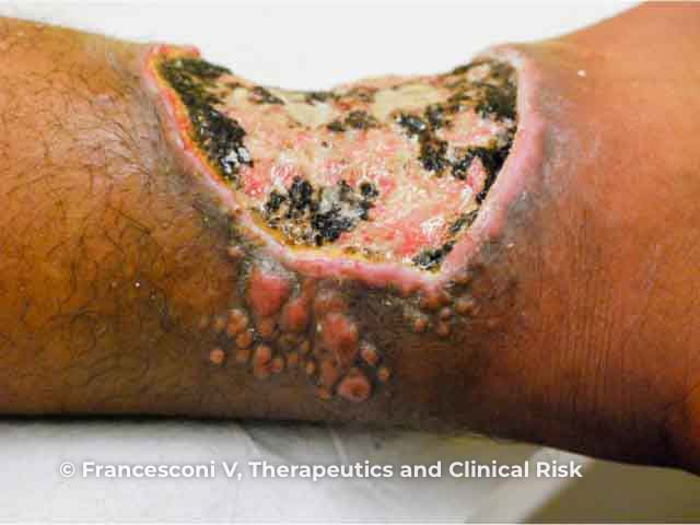 Deep fibrotic ulceration on the ankle due to lobomycosis