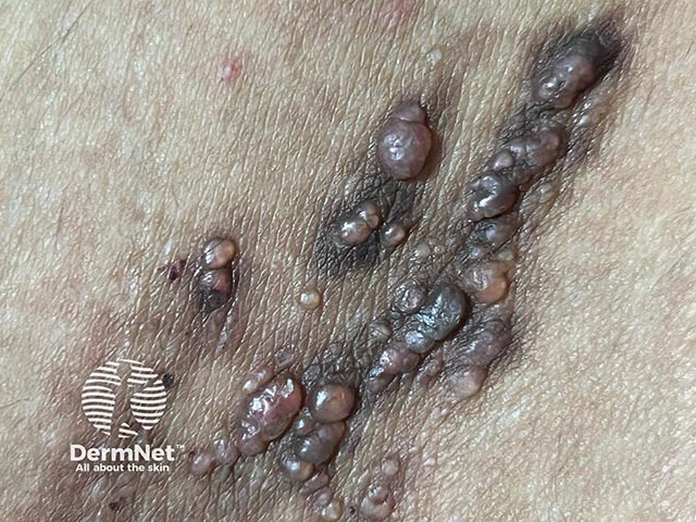 Clustered vesicles resembling rice krispies / rice bubbles due to lymphangioma circumscriptum