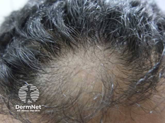 Frontal androgenetic alopecia