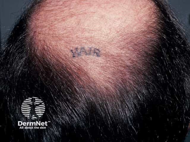 Androgenetic alopecia at the vertex 