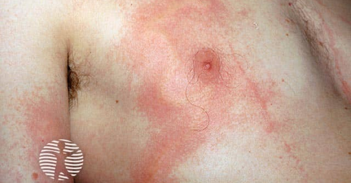 melanotan tan australia Abnormal moles seen developing in patients chasing perfect suntan by using  peptide melanotan-II
