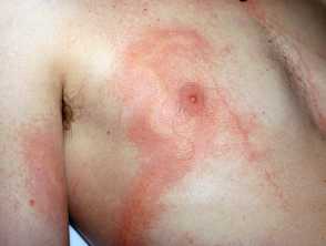 nematocysts on skin
