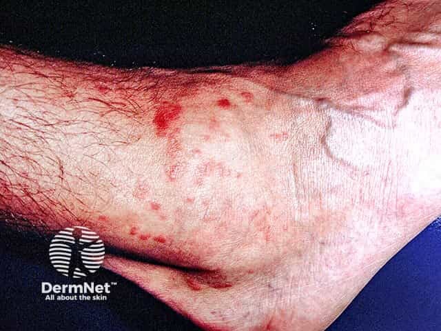 Urticated papules after accidental exposure to fire coral on the ankle in a scuba diver