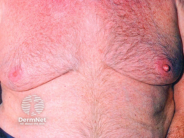 Redness, tenderness and oedema of the nipple in a man with mastitis of the left breast