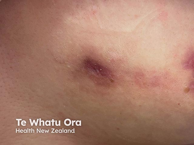 A discharging plaque on the breasts due to idiopathic granulomatous mastitis