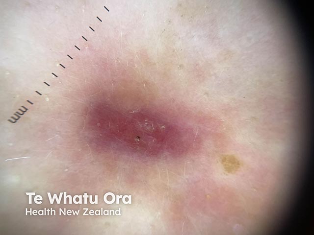 Dermoscopy of an area of idiopathic granulomatous mastitis