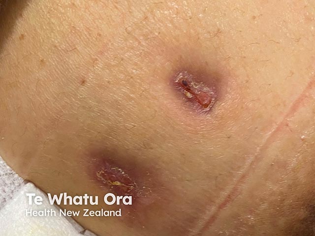 Discharging lesions on the breast due to granulomators mastitis