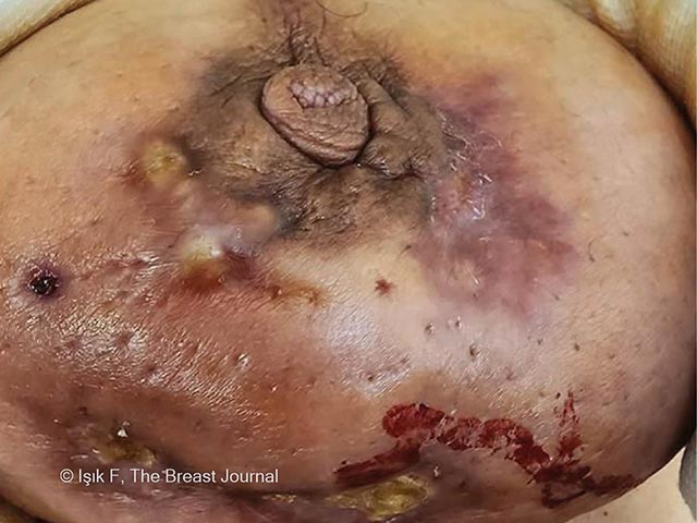 Indurated discharging and scarring of the breast due to granulomatous mastitis