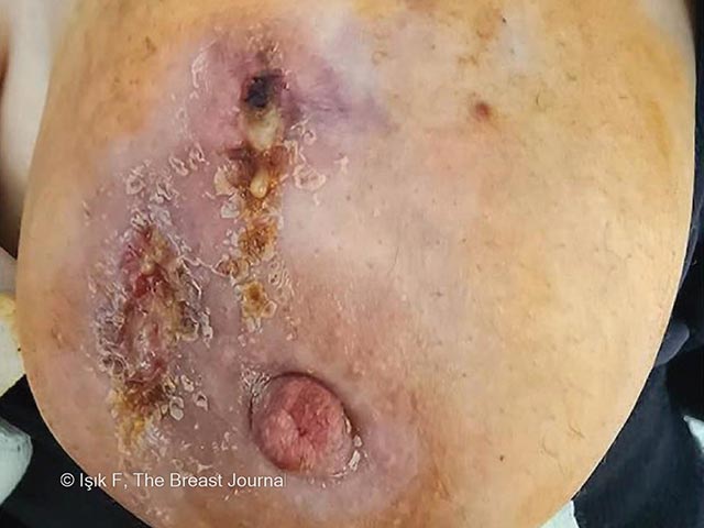 Breast ulceration and induration due to granulomatous mastitis