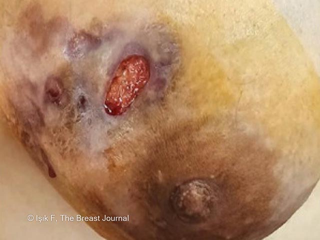 Ulcerated area on the breast due to grannulomatous mastitis