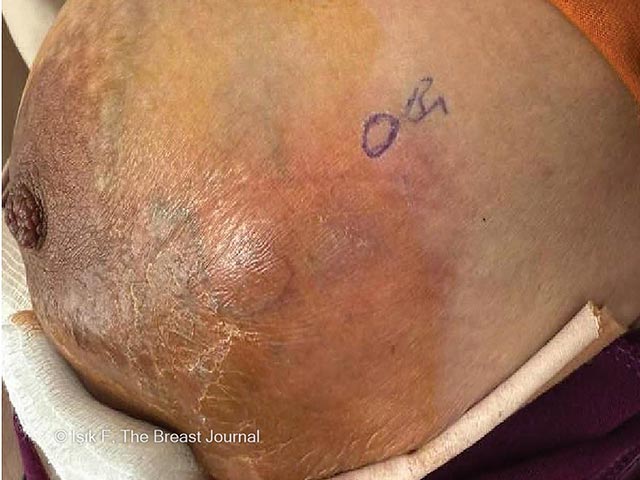 Granulomatous mastitis 