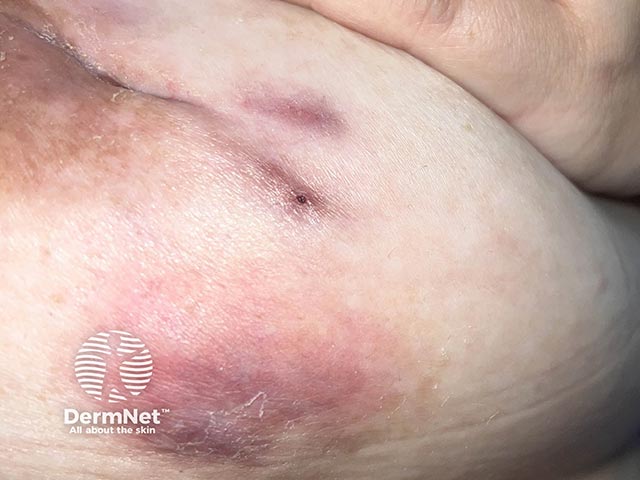 Erythema and induration over the breast in idiopathic granulomatous mastitis 