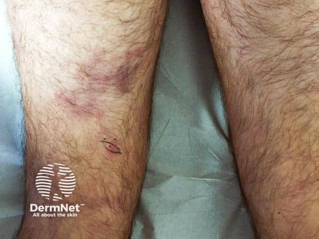 Livedo reticularis was the result of a medium-size-vessel vasculitis; associated cerebral vasculitis resulted in coma